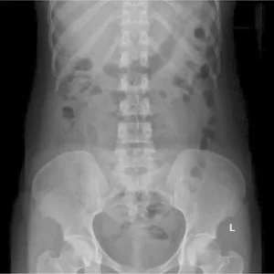 RX ABDOMEN SIMPLE