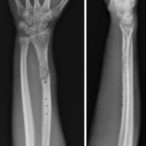 RX ANTEBRAZO