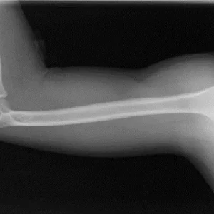 RX BRAZO