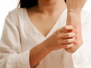 PERFIL URTICARIA